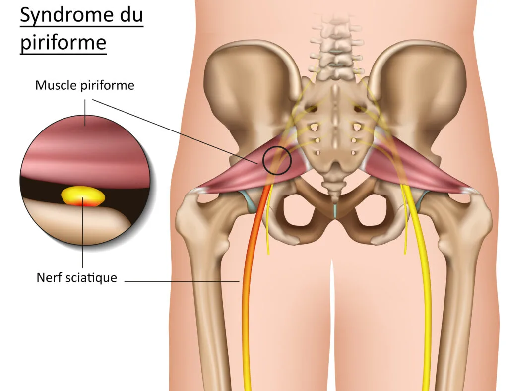 Syndrome du Piriforme